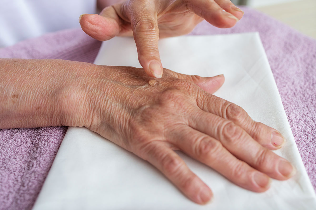 Reducir los síntomas de la artritis reumatoide 47