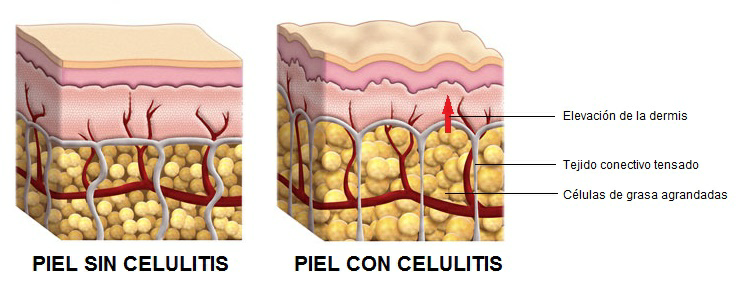 Celulitis (lipodistrofia ginecoide) image001(14)